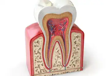Molde de diente con estructura interna, raíces y pulpa, mostrando anatomía odontológica para ilustrar temas de salud oral y odontología.