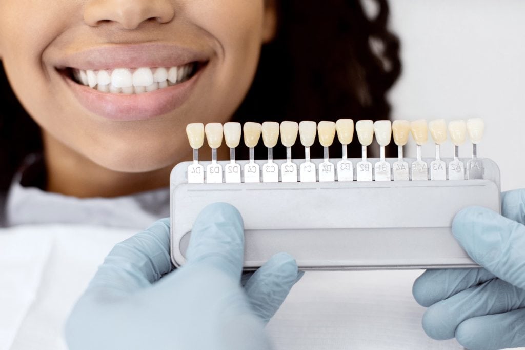 Blanqueamiento dental en laboratorio, muestra de colorantes en escala para evaluar tonalidades, sonrisa saludable, odontología estética, control de color dental, sonrisa perfecta. – SoyMigrante.com REVISTA