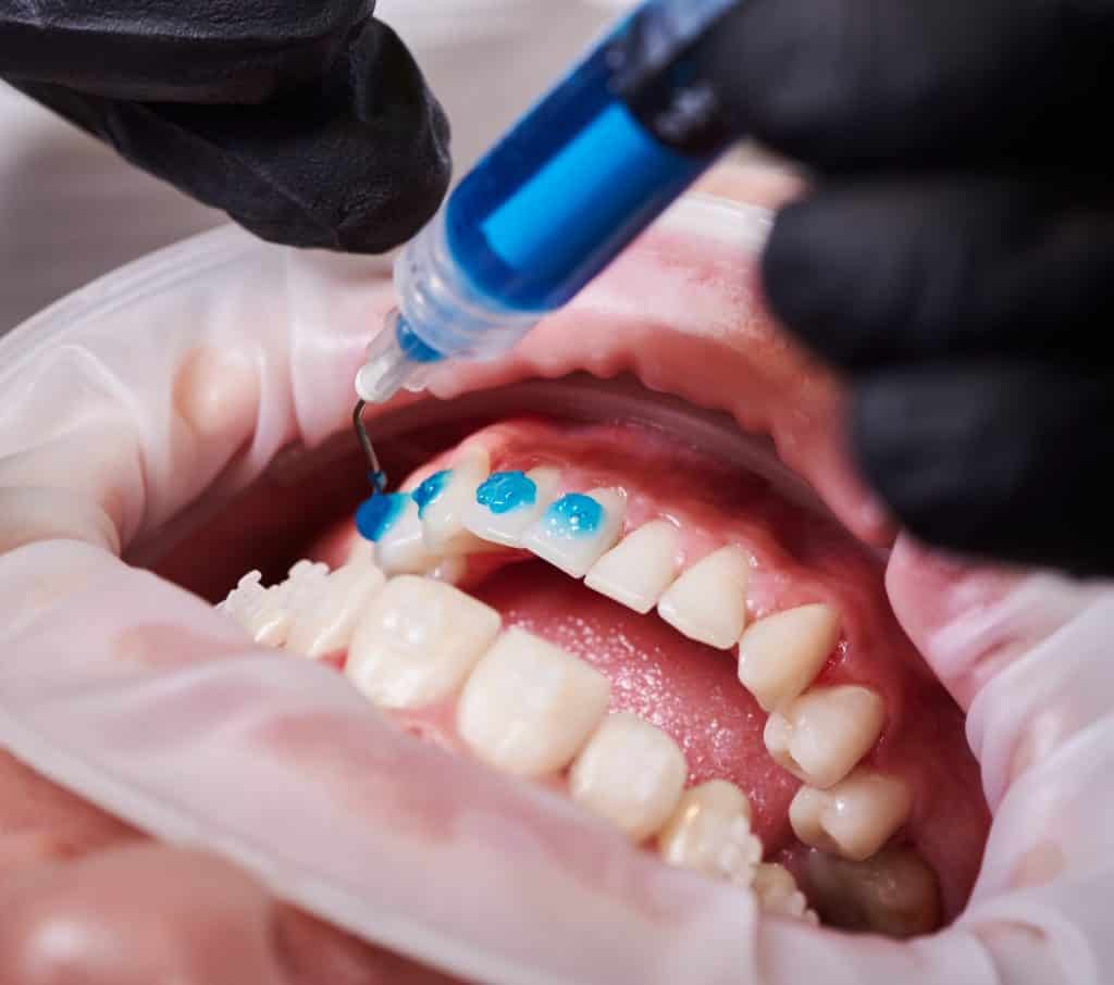 Técnico realizando tratamiento de fluoración dental en joven paciente, enfoque en salud bucal y prevención de caries, en consulta odontológica moderna.