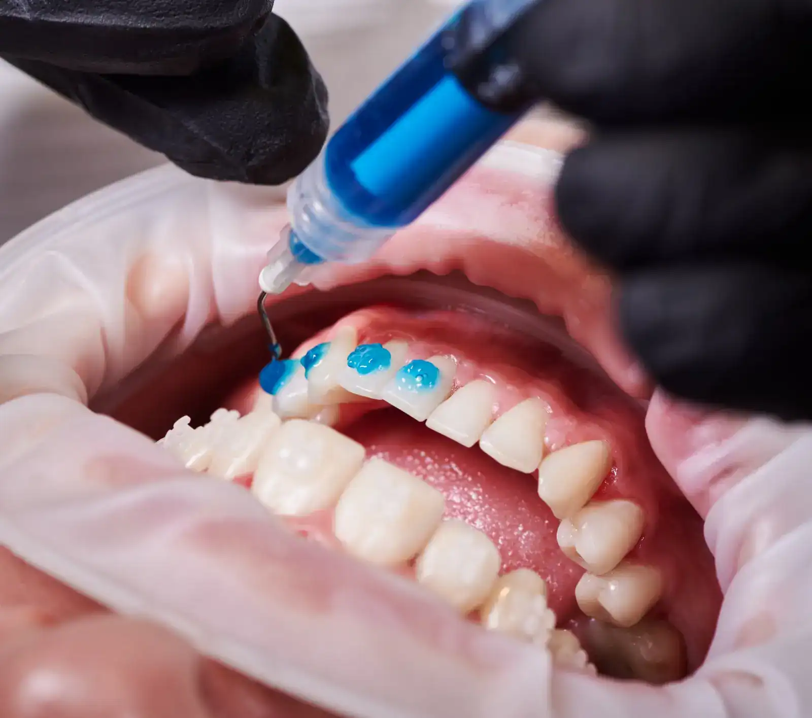 Blanqueamiento dental: ¿una moda segura o un riesgo?