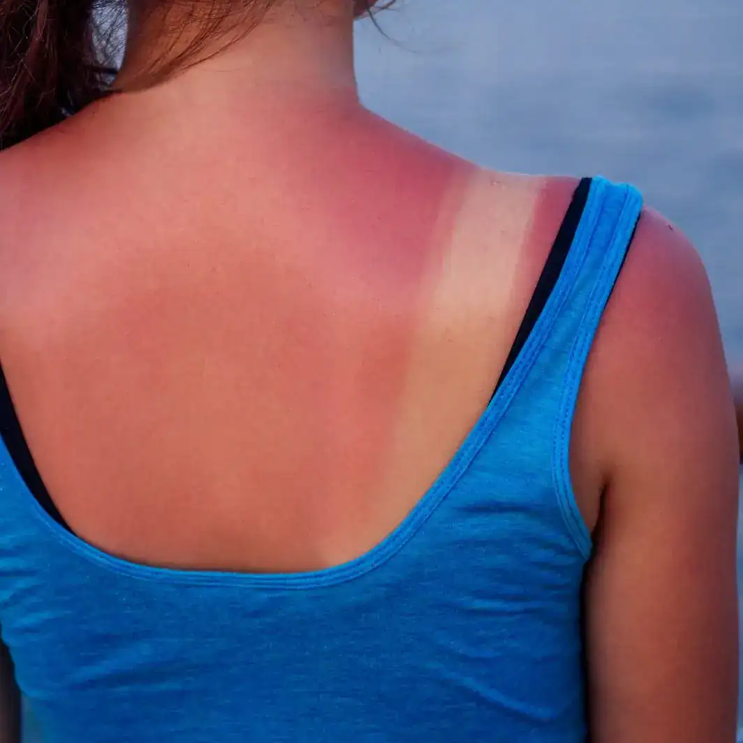 ¿Quemadura solar? Esto hay hacer prevenir o aliviar